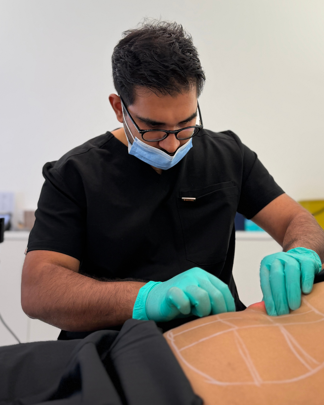 Dr Karwal performing, Endolift for the abdomen at Karwal Aesthetics, London.