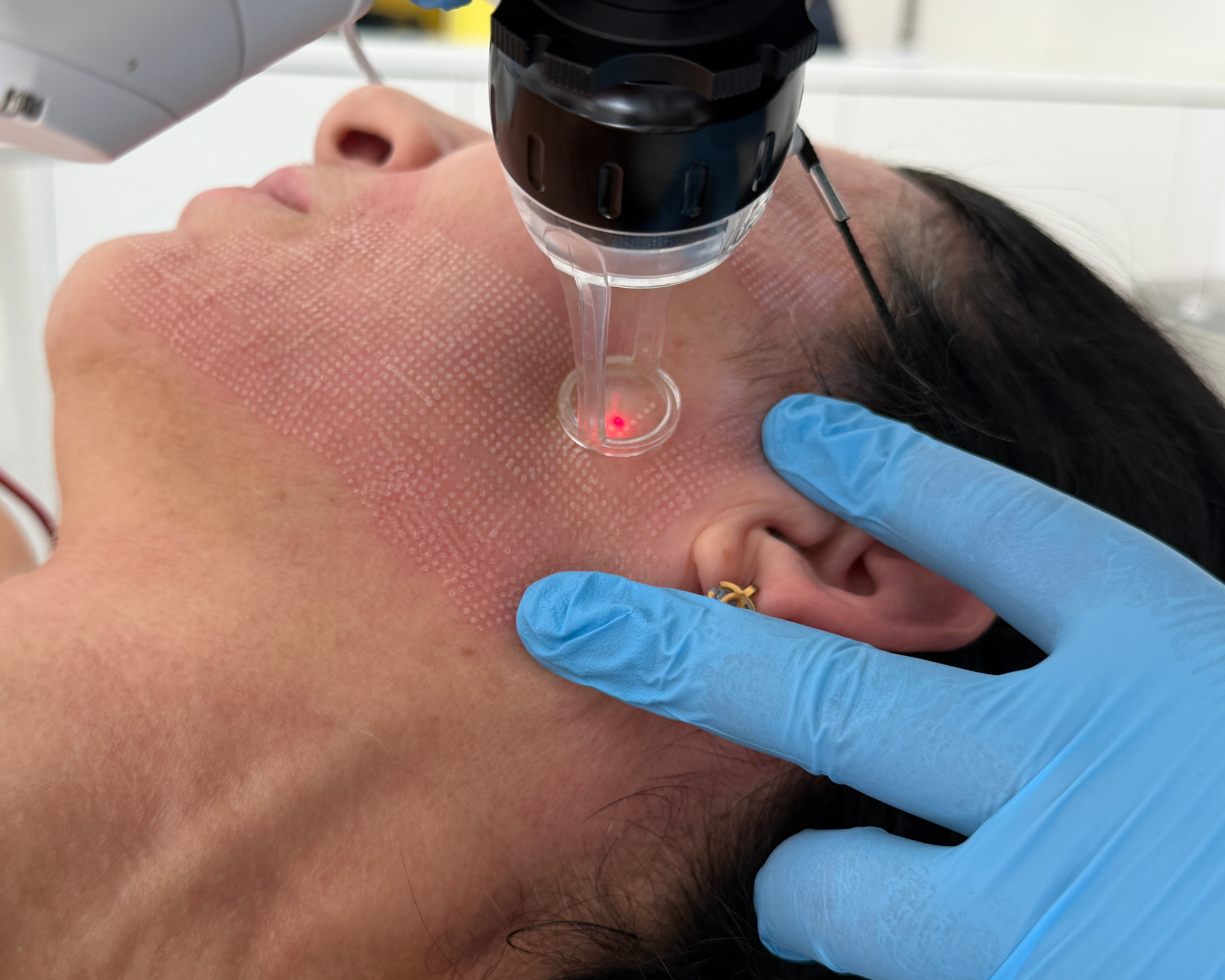 Dr Karwal performs fractional CO2 laser resurfacing using the Lumenis AcuPulse to treat scarring, texture and pigmentation at Karwal Aesthetics, London.