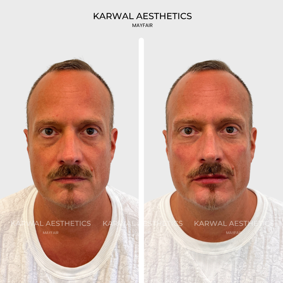 Cheek filler, lip filler, under eye filler male result, London.