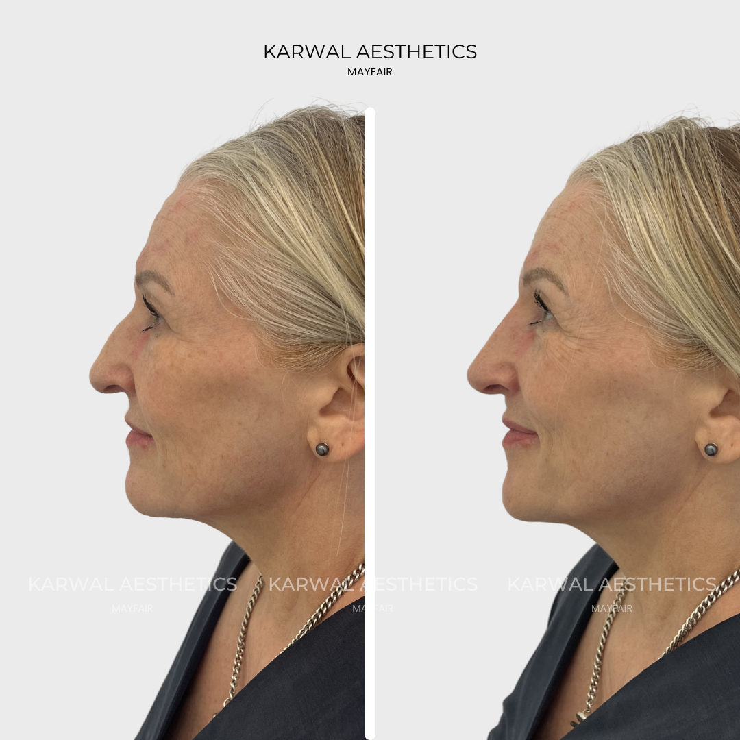 non surgical rhinoplasty before and after