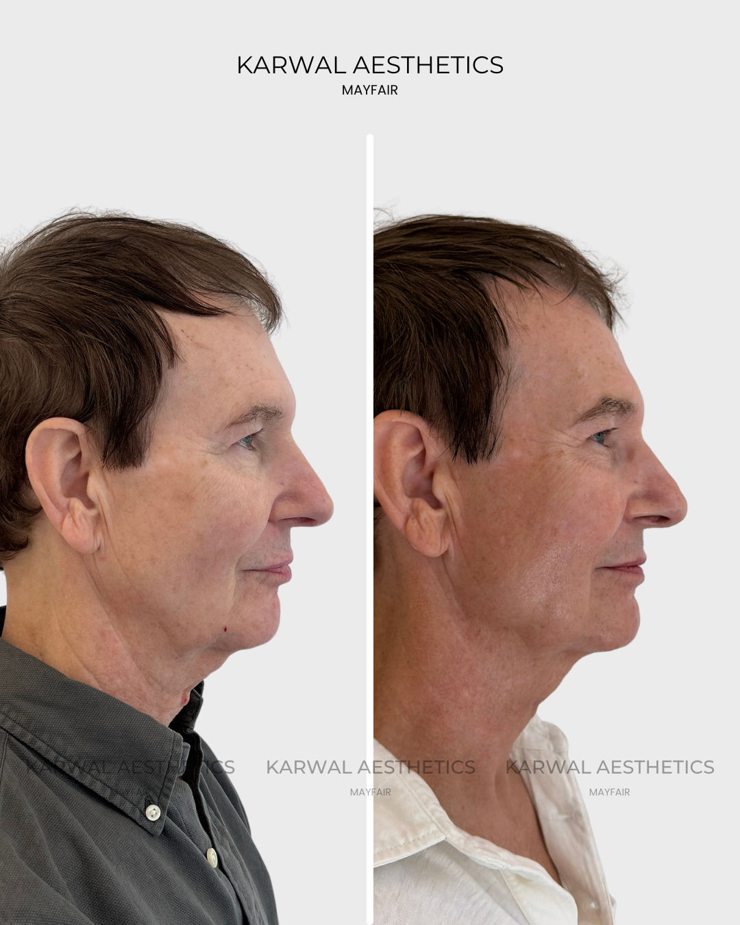 MAYFAIR MAYFAIR Karwal Aesthetics Karwal Aesthetics Karwal Aesthetics MAYFAIR