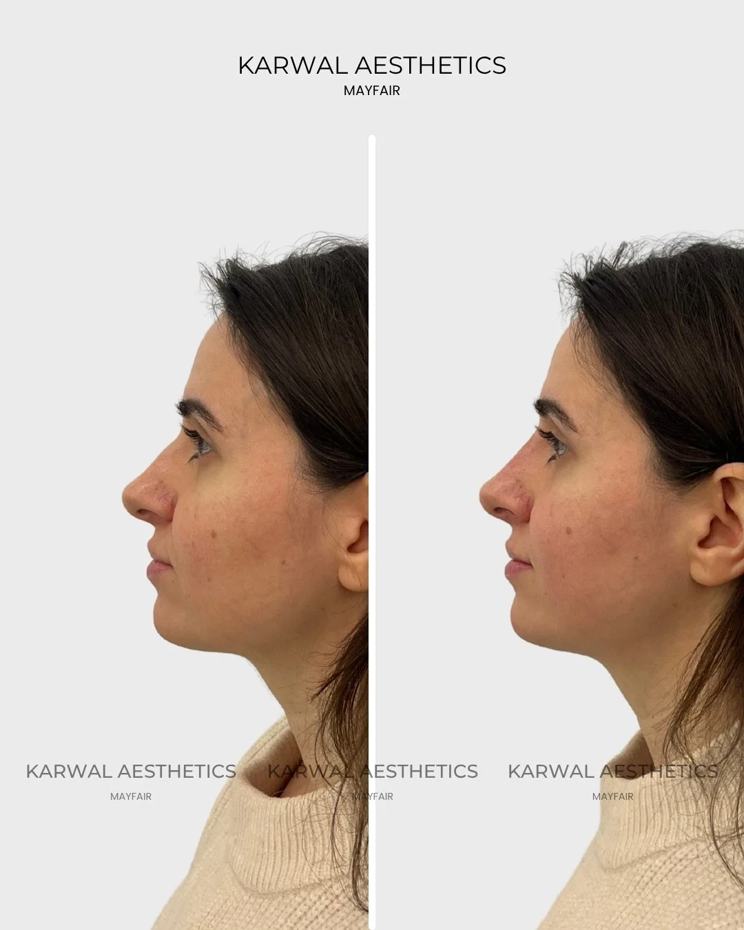 Non Surgical Rhinoplasty Result Karwal Aesthetics