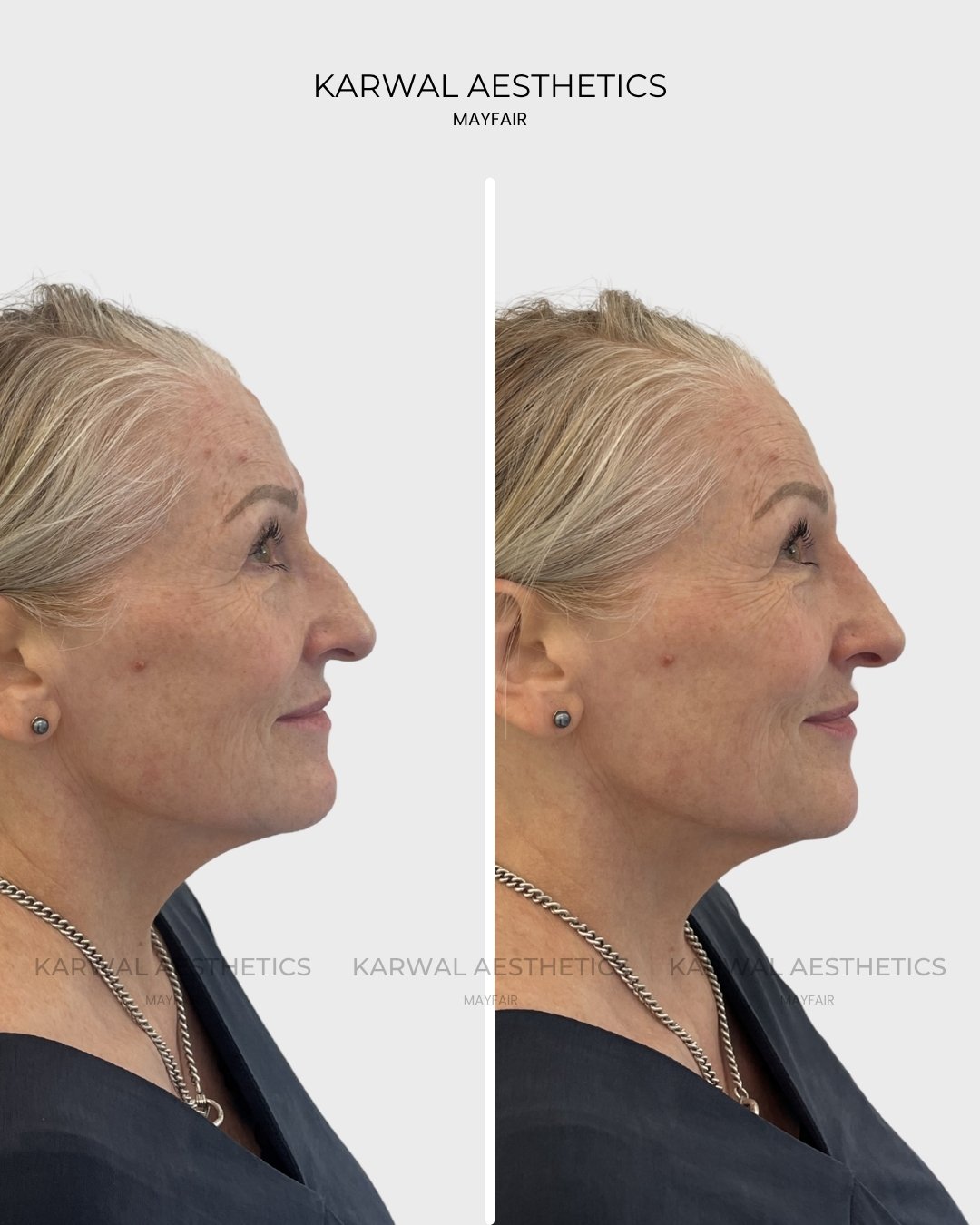 Non Surgical Rhinoplasty Result Karwal Aesthetics