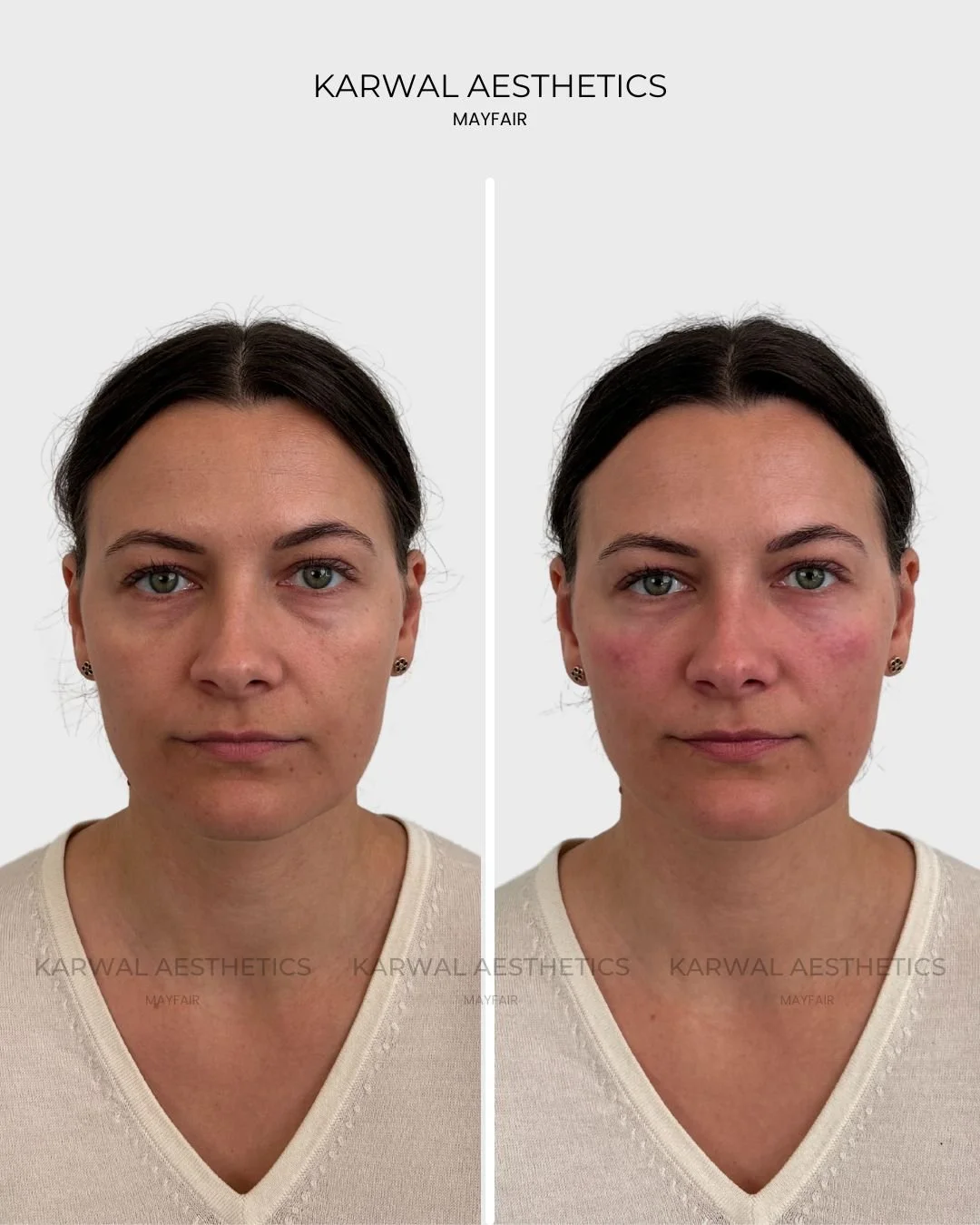 Under Eye Filler Before and After