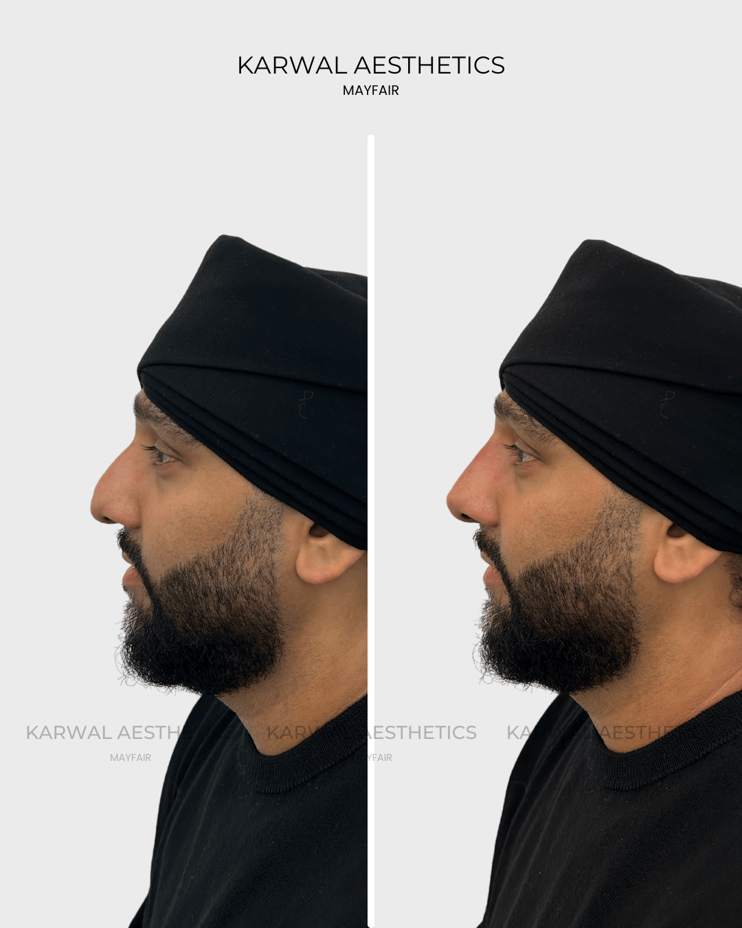 Non surgical rhinoplasty Karwal Aesthetics result London