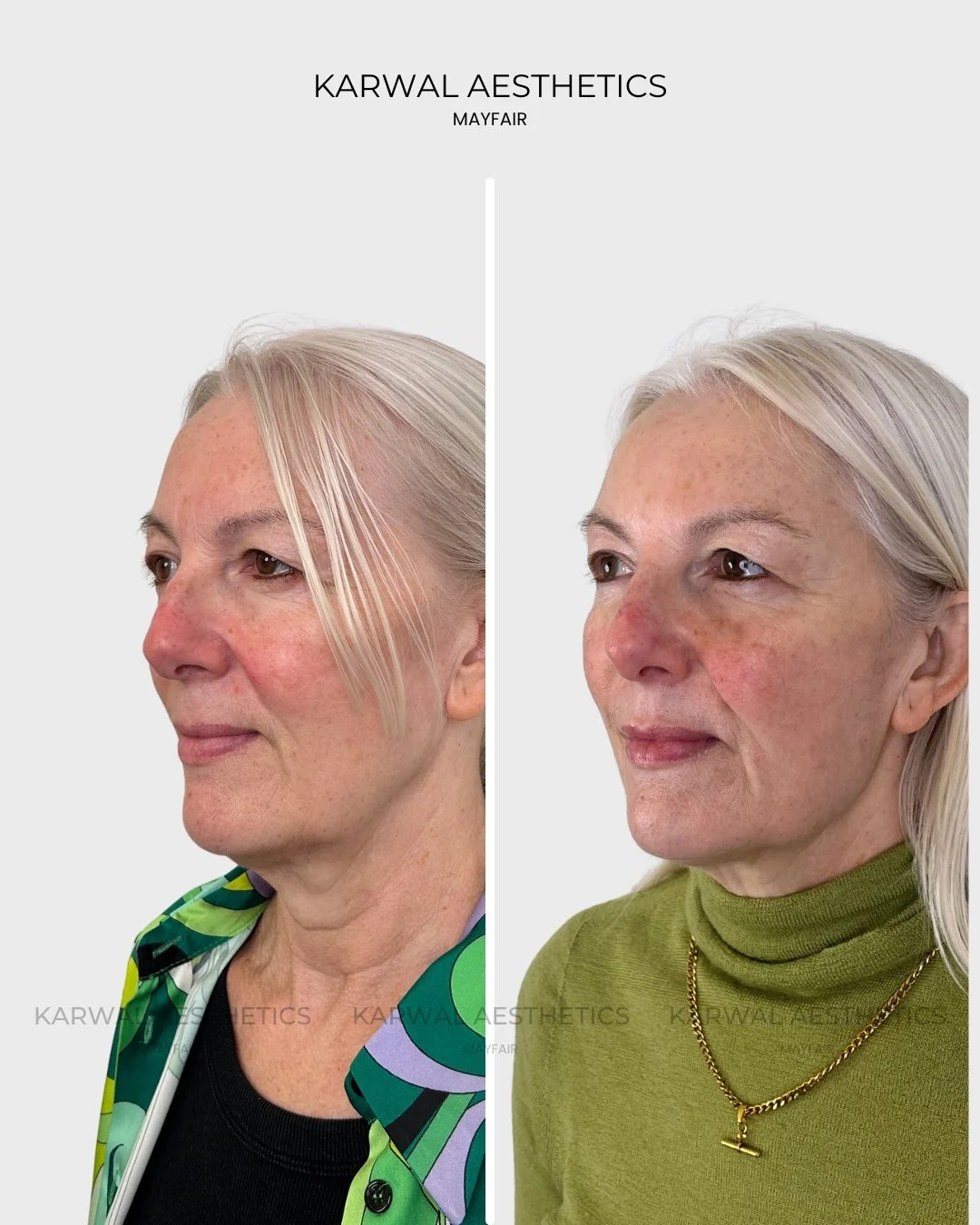 Endolift before and after - Karwal Aesthetics London