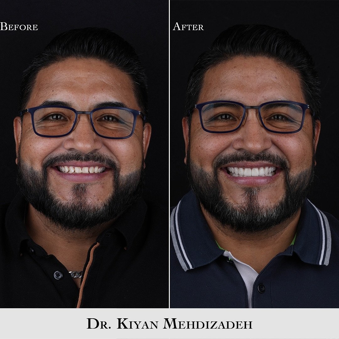 Upper &amp; lower porcelain veneers 
.
.
Book a complimentary consultation with us! 
📱 Text us: 310.770.3335
📞 Phone: 310.770.3335
✉️ Email:&nbsp;info@drkiyan.dental
.
💳 Monthly payment plans available
📍 Beverly Hills &amp; San Diego