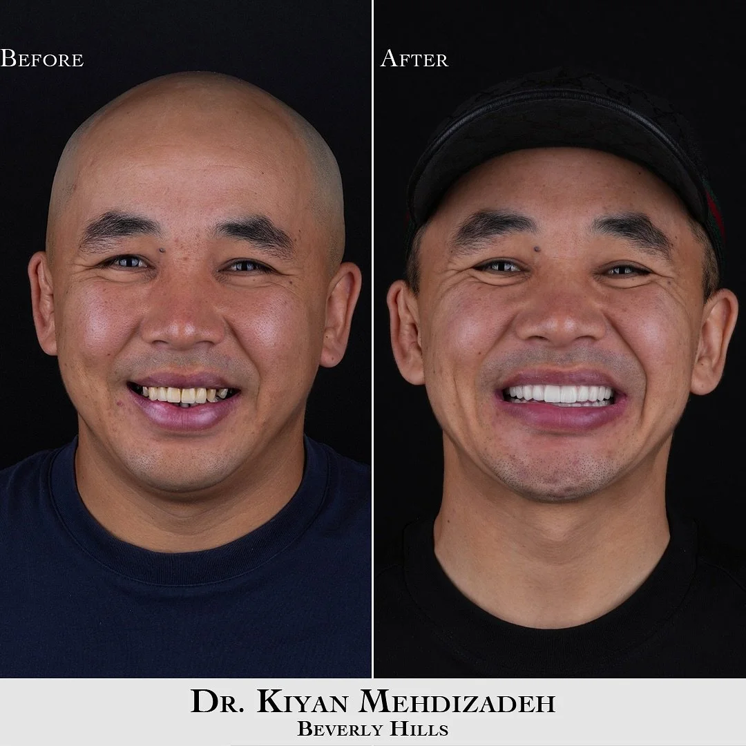 Upper/lower implant supported bridges.
.
.
Book a complimentary consultation with us:
📱 Text us: 310.770.3335
📞 Phone: 310.770.3335
✉️ Email:&nbsp;info@drkiyan.dental
.
💳 Monthly payment plans available
📍 Beverly Hills
.
#allonfour #dentalimplant