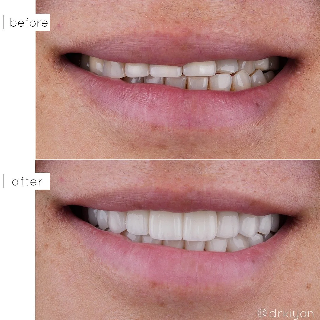 We are excited to share the final outcome of this transformative case. Our patient initially came to us seeking to enhance the aesthetics of her smile, but a comprehensive treatment plan was necessary to address several underlying concerns. She prese