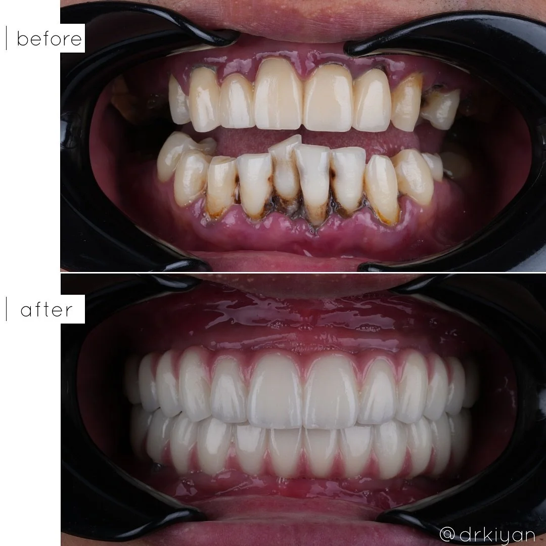 Gorgeous all-on-4 case completed for an amazing patient. He came to me feeling unsure about where to start. It is important in a case like his to work with a team who has experience in handling all aspects of the case. The first step was removing the