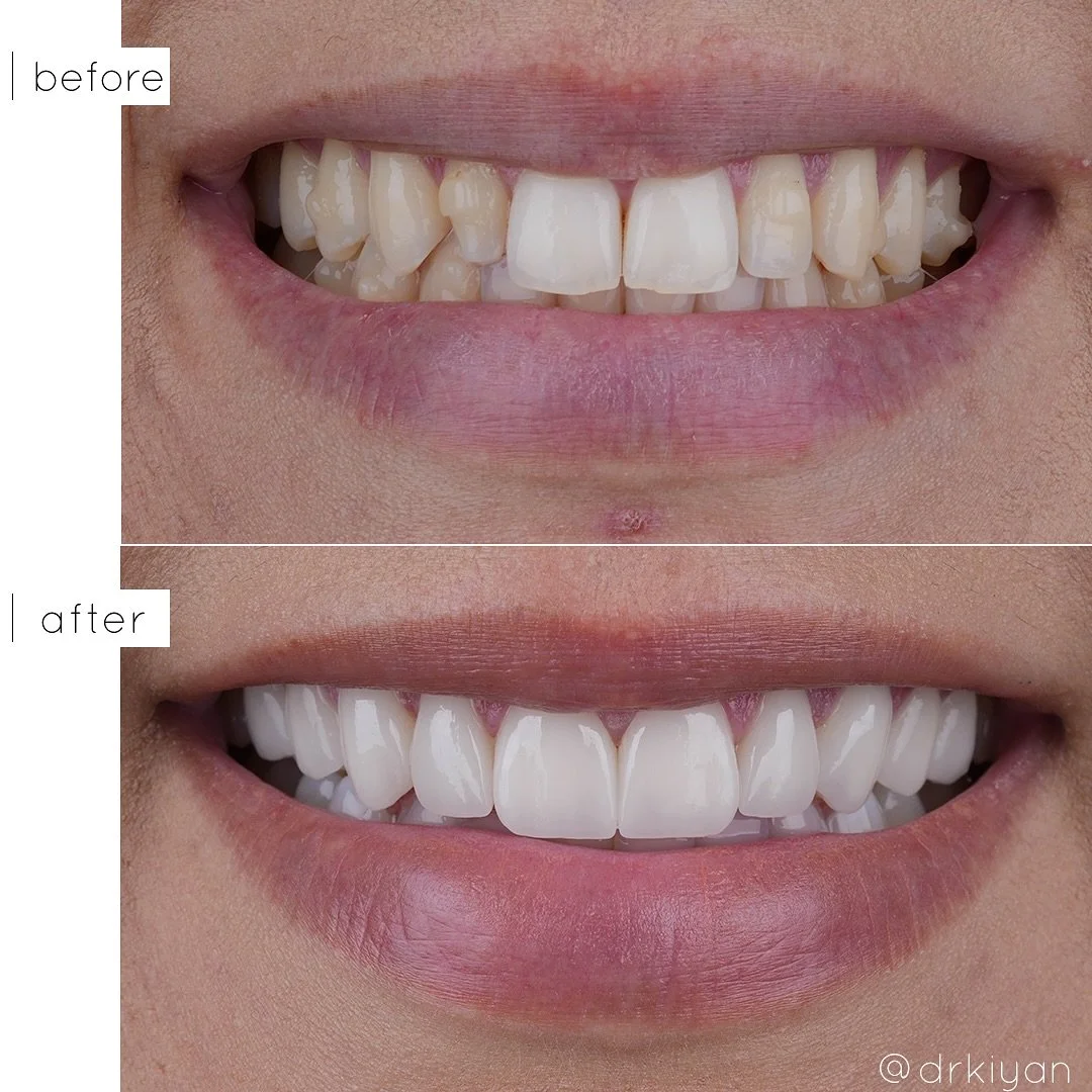 This lovely client had finished Invisalign, but was still unhappy with the overall shape of her teeth. She had genetically small peg laterals and wanted a permanent solution to improve symmetry in her smile. With 10 upper veneers we created a smile t