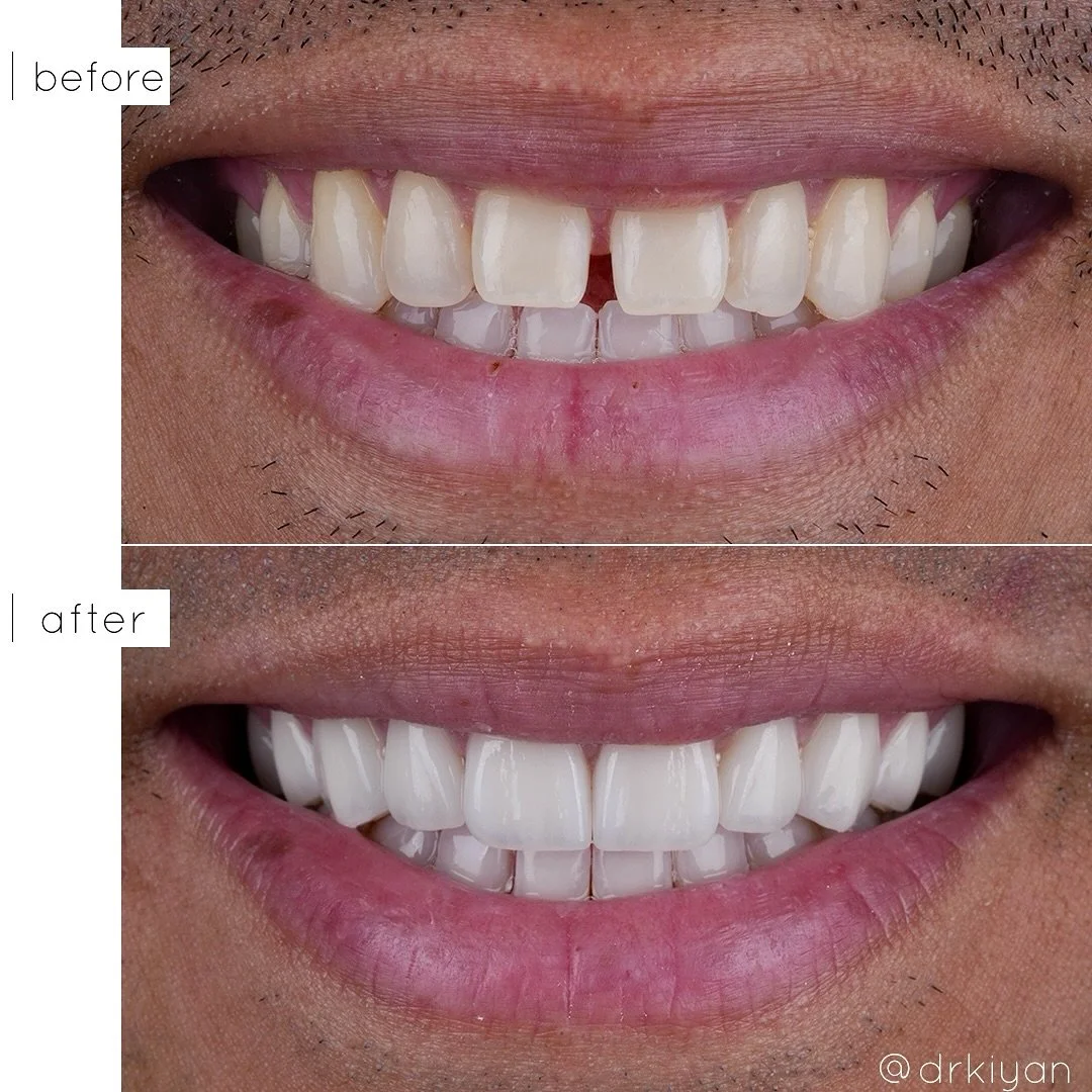 This wonderful client sought to close the gap in his smile and achieve greater symmetry in the shape of his teeth. Although he had previously attempted to address the gap with Invisalign, the space reopened over time.

Typically, male patients often 