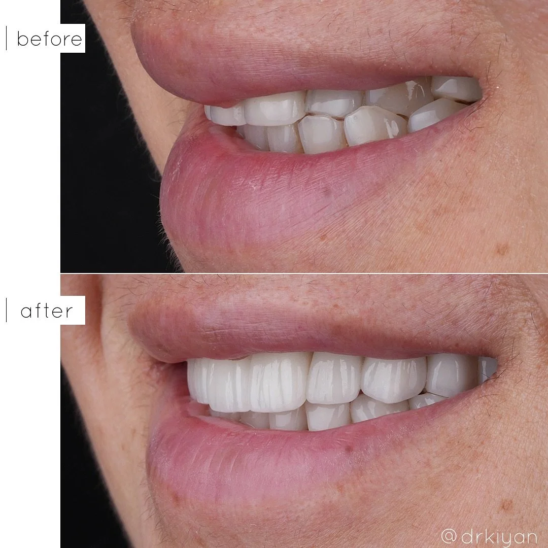 Gorgeous case completed with a combination of multiple implant-supported bridges, veneers, and crowns. She presented with multiple failing root canals and prior dental work completed in another country that had resulted in significant bone loss and t