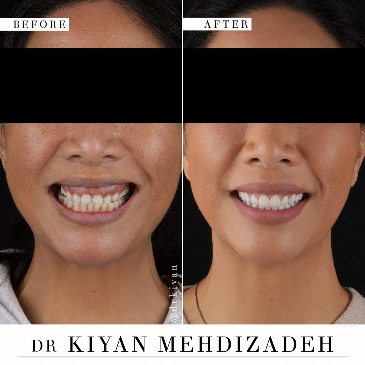 Would you have guessed the sole change here is dental work?
&bull;
&bull;
The impact of a smile makeover goes beyond the teeth.

Balancing the gum line and restoring proper tooth proportions with veneers changes the entire lower face. The smile now f