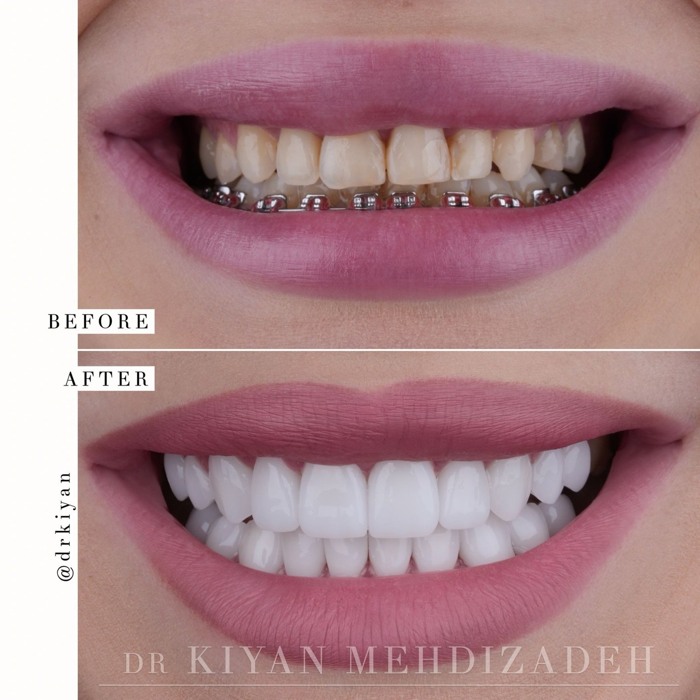 After a disappointing result from braces, this lovely patient wanted to take her smile to the next level. 

We created a holistic plan that not only improved her bite and smile, but also replaced two missing teeth in the back. With a combination of p