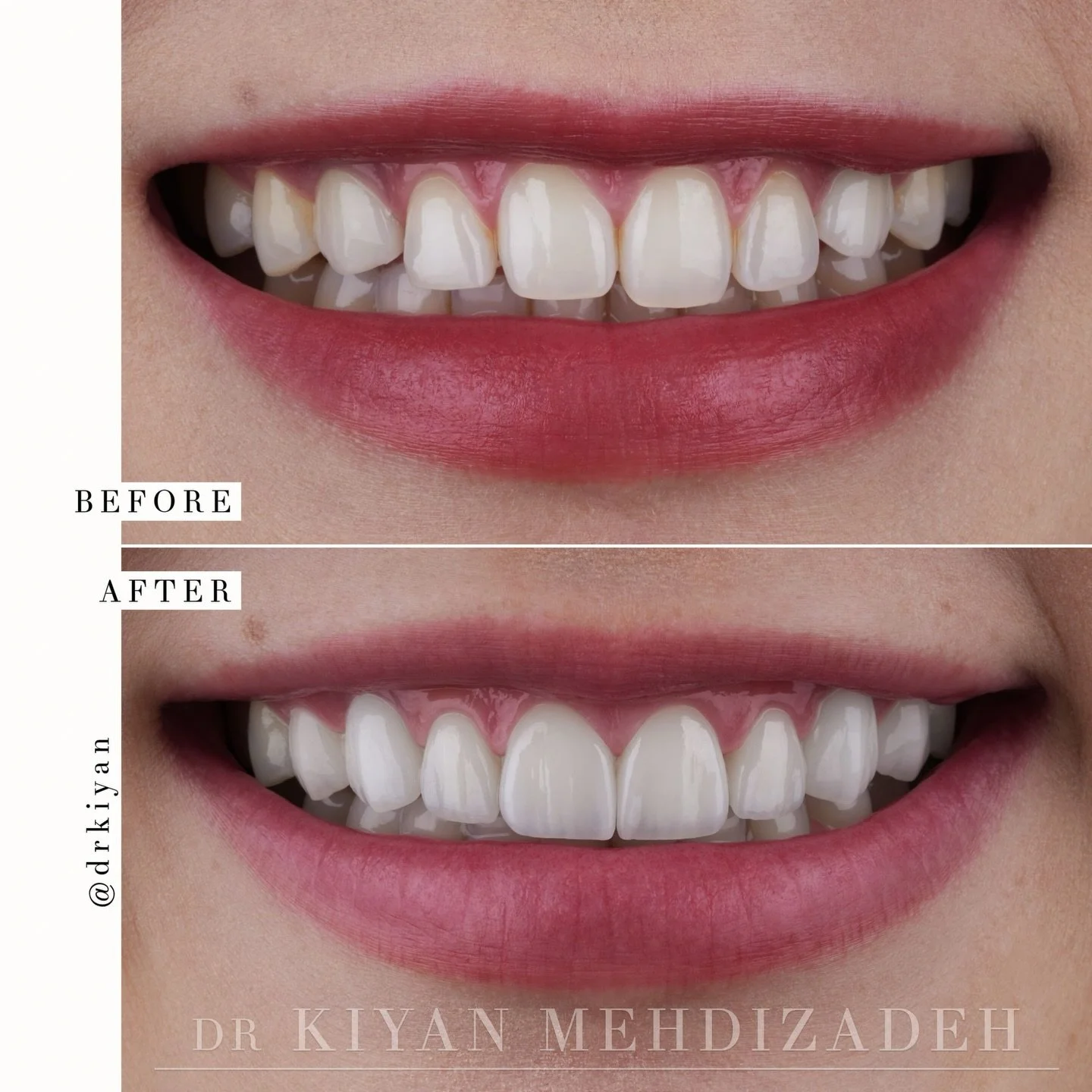 This lovely patient was congenitally missing upper canine teeth. 

In her youth, she got implants to replace the missing teeth. However, since they were placed during adolescence, her natural teeth kept shifting during development while the implants 