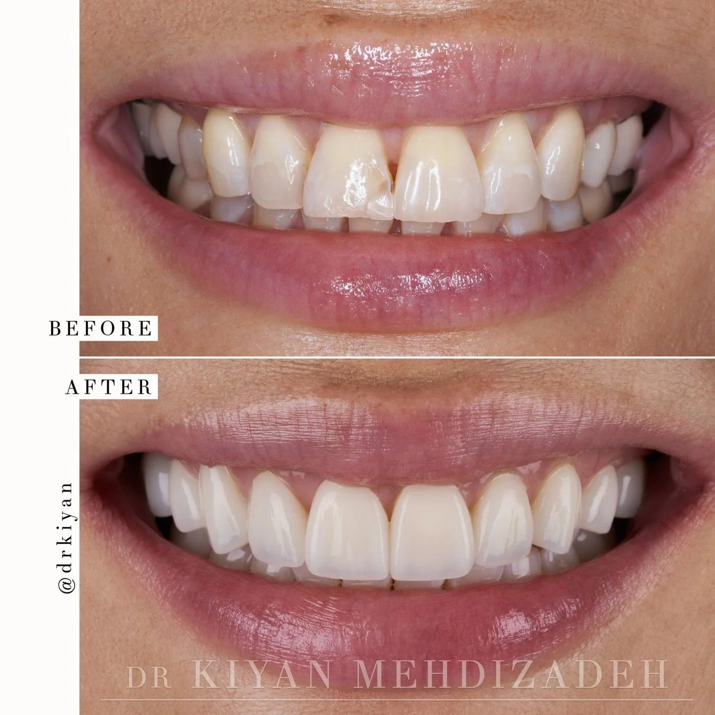 This lovely patient wanted to refresh her smile and sought a permanent solution for the chipping at the edge of her front teeth. Having previously addressed the damage with composite bonding, she recognized that this &ldquo;fix&rdquo; lacked durabili
