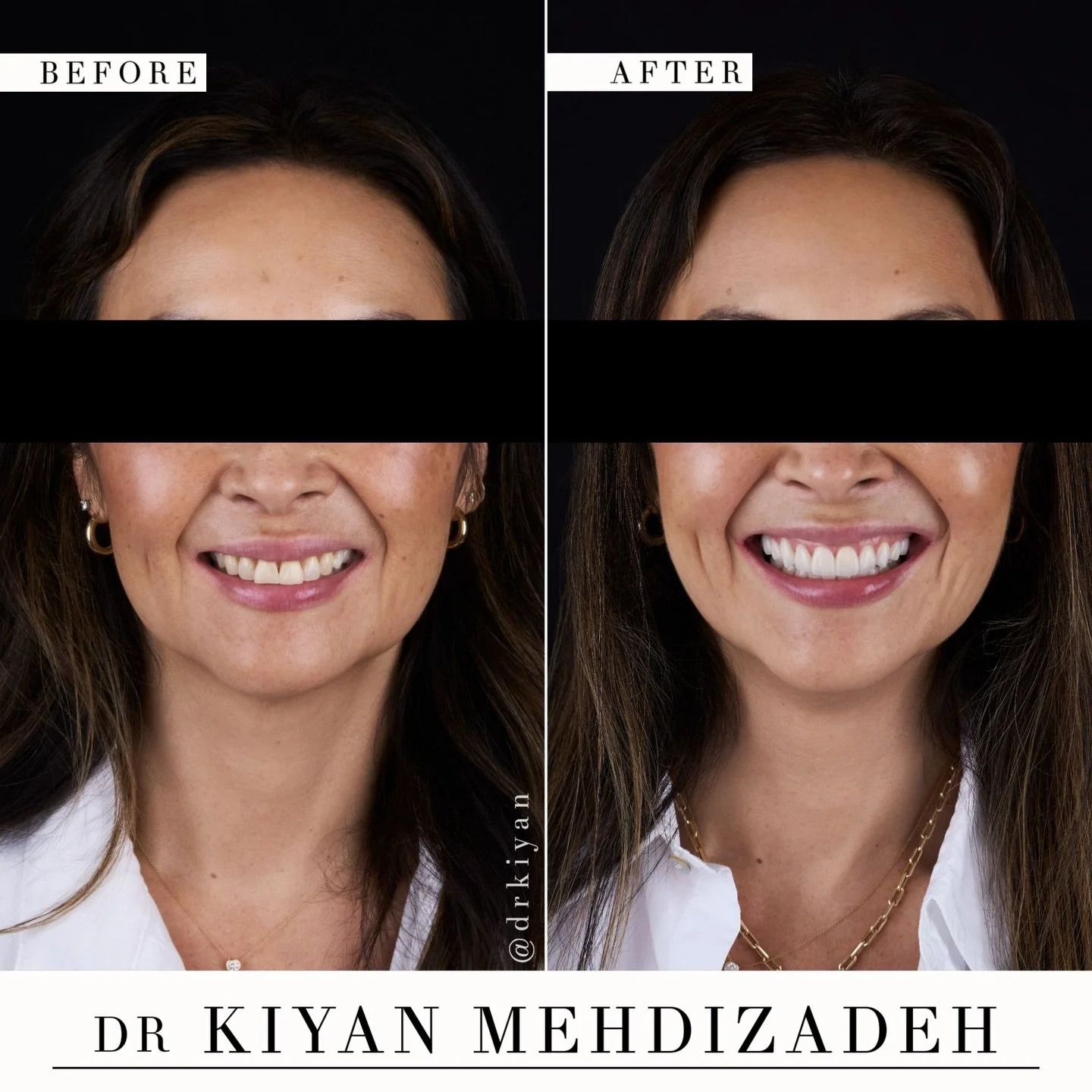 A smile transformation like this provides more than just a solution to a problem&mdash; it brings back confidence.

Our wonderful patient wanted to address the chipping damage between her front teeth as well as two missing molars. She sought an overa