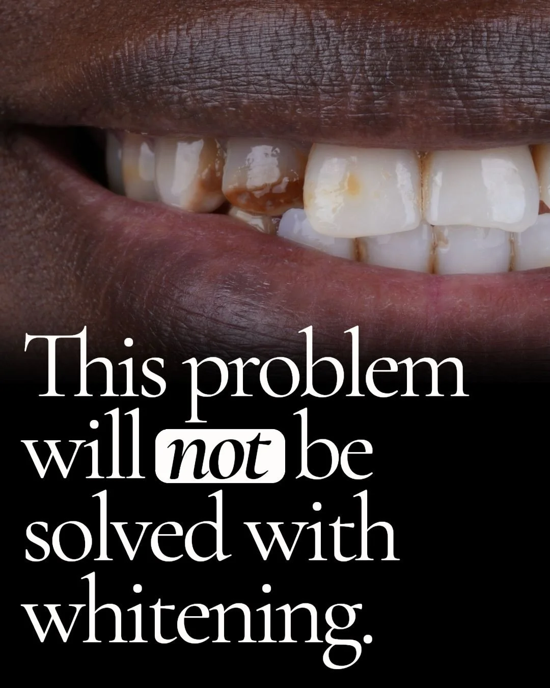 Fluorosis may not be common, but it is intimidating.

Many people suffering from fluorosis are unsure of what caused the problem, if it is purely cosmetic, or if it can be treated at all. Some attempt to whiten the discoloration, but that often makes