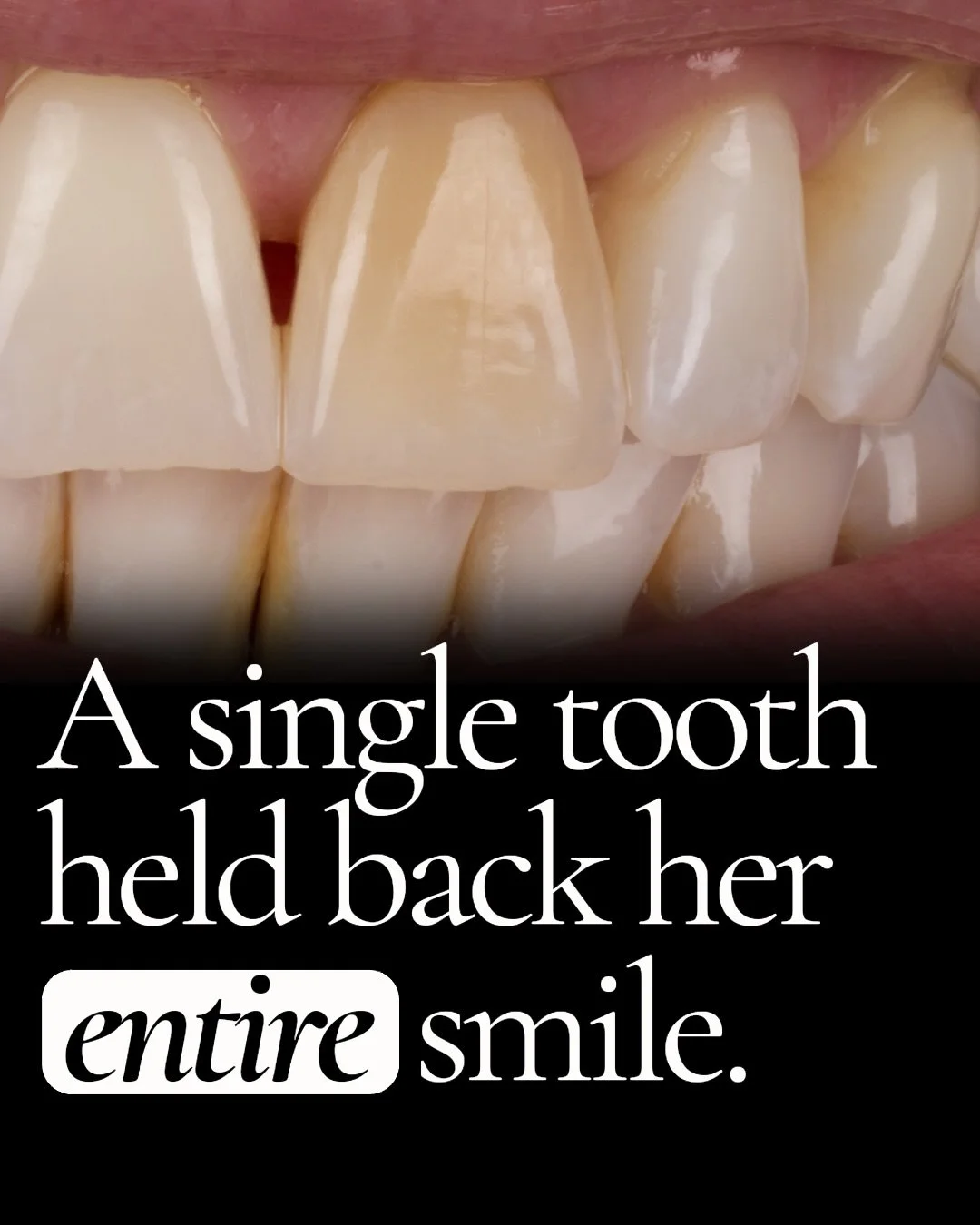 No one should feel the need to hide their smile.

This lovely patient&rsquo;s front tooth was traumatized years ago. Over time, it began to change color&mdash; the darker it became, the more she sought a solution. The issue she faced was that every p