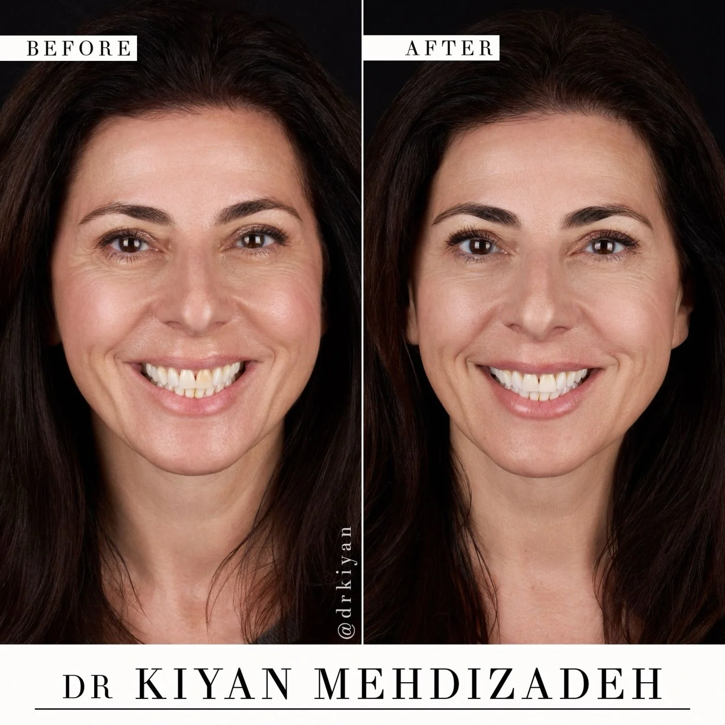 A dramatic transformation doesn&rsquo;t always require dramatic treatment.

This lovely patient sought a permanent solution to the discoloration in her front tooth, but was not interested in veneers. Her tooth had undergone physical trauma years prio