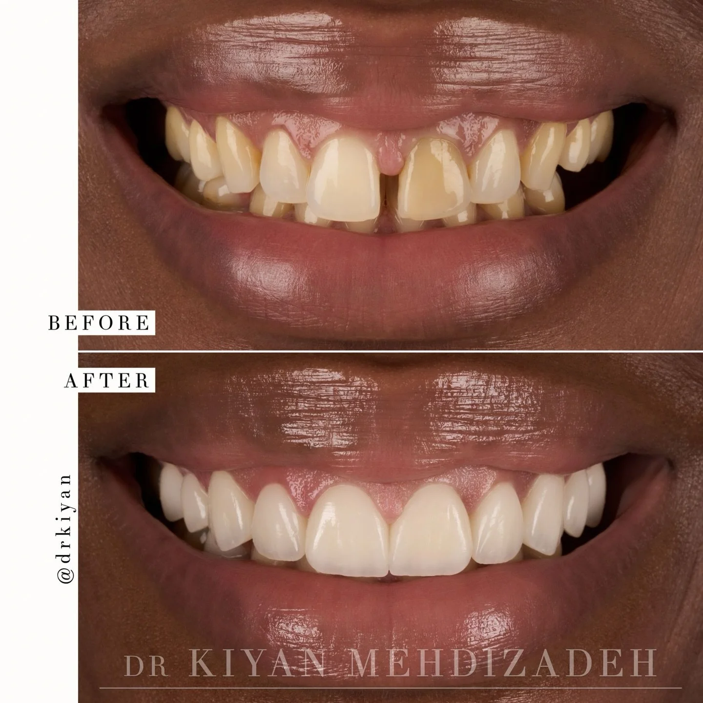 This wonderful patient wanted a total smile refresh.

Her main aesthetic concerns were the uneven color in her smile and the gap between her front teeth. Many people are fond of their gap&mdash; also called a diastema&mdash; but for others, it can be