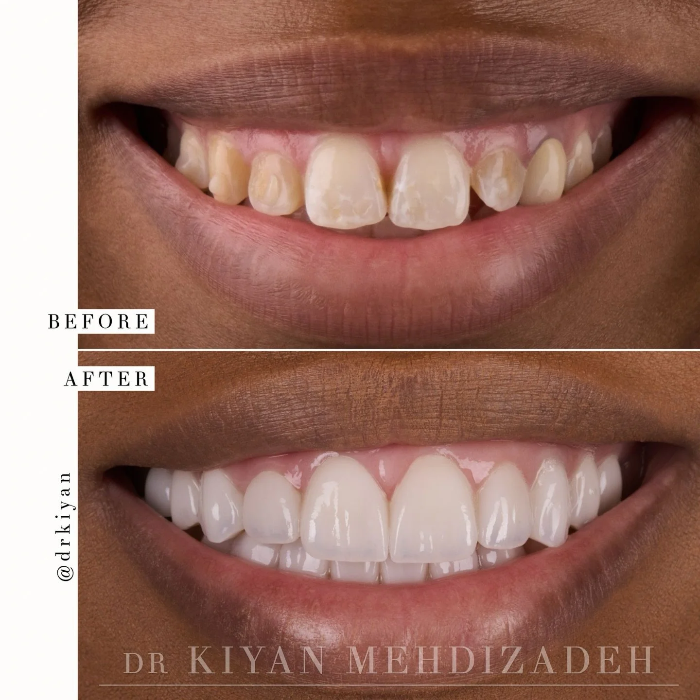 This lovely patient sought a complete smile transformation.

After braces, her teeth were aligned, but the shape of the teeth themselves created uneven gaps. She wanted to refresh her smile by introducing symmetry and filling the spacing that remaine