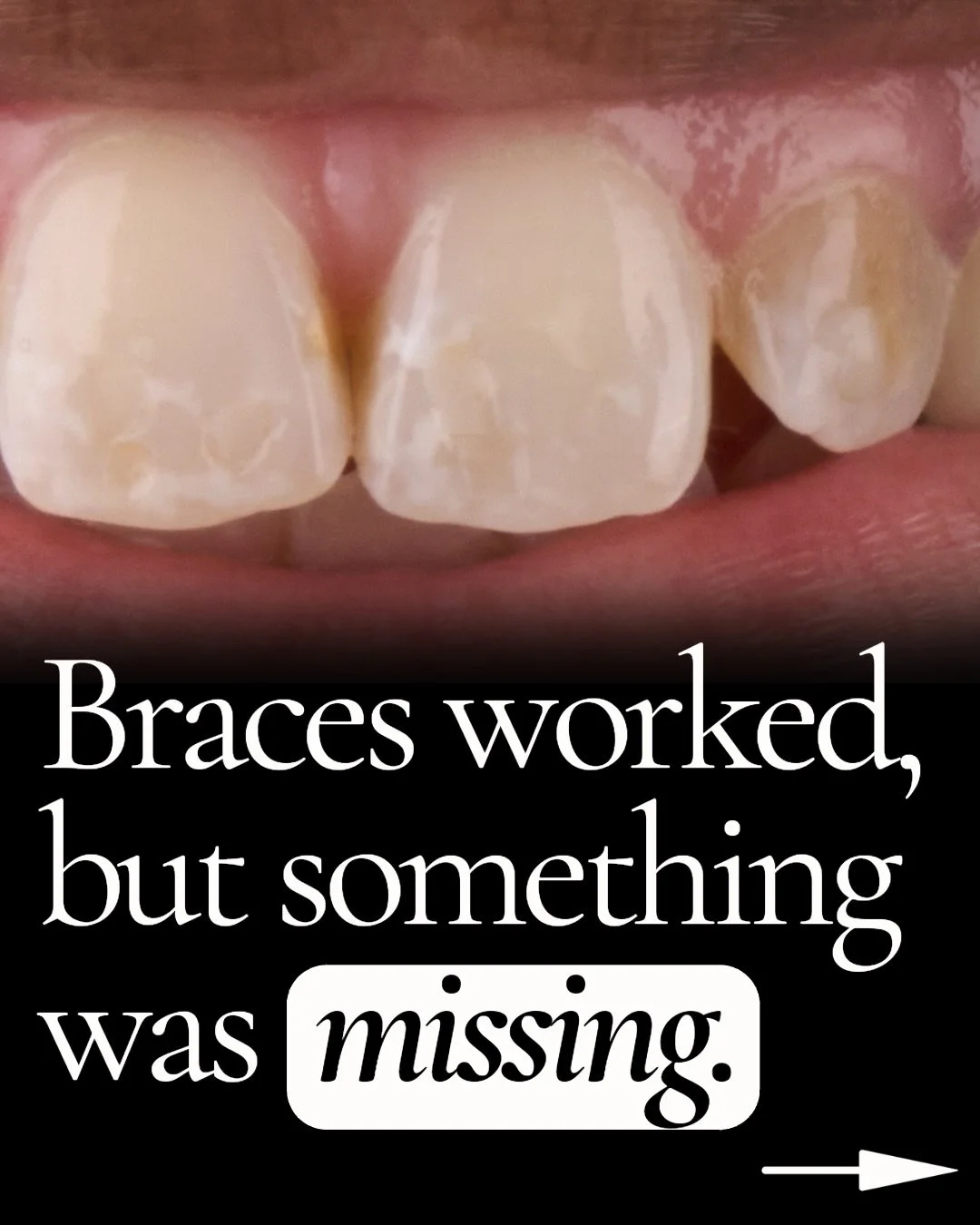 She expected braces being final step of her smile journey&mdash; in reality, it was just the start.

After spending a significant amount of time aligning her teeth, her smile still felt incomplete. Her teeth were straight, but remained discolored, as