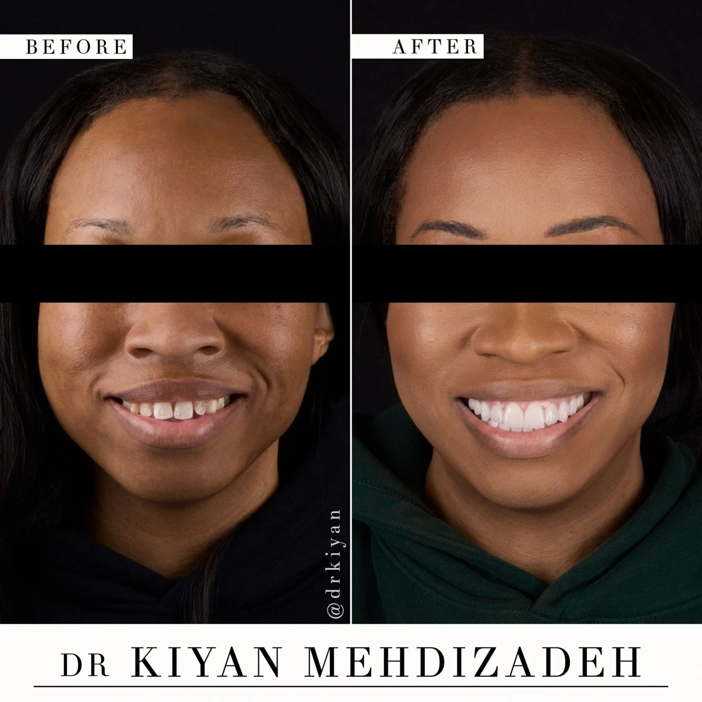 This patient wanted a smile restoration beyond what aligners could accomplish.

After braces, her teeth were straight, but she remained unhappy with her smile. Discoloration, asymmetry, and small spaces between her teeth resulted in a loss in confide
