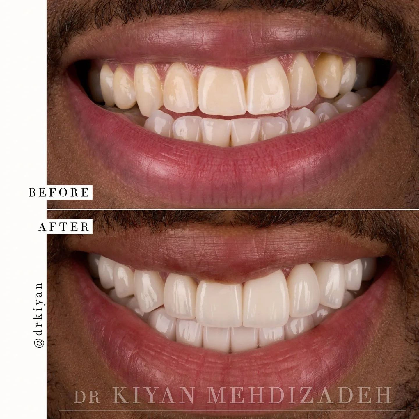 This patient traveled from Chicago to rebuild his smile.

In addition to aesthetic concerns, the primary issue he wanted resolved was his underbite. Typically, treating this condition involves major jaw surgery with a lengthy recovery period; however