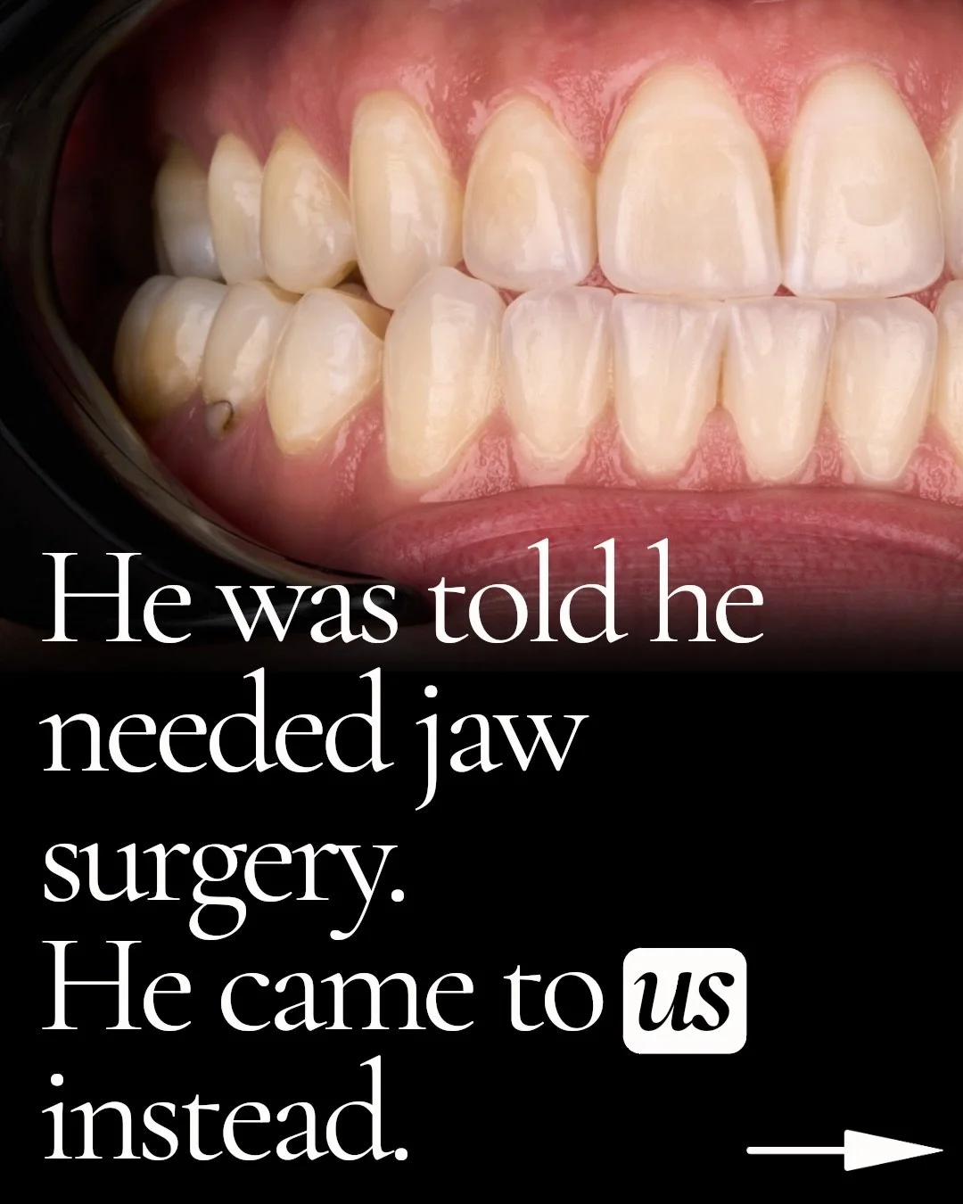 He thought his underbite could only be addressed by altering his jaw.

We provided a different solution.

Instead of undergoing surgery to correct his bite, rebuilding his smile offered a less invasive long-term option.

His smile was truly restored&
