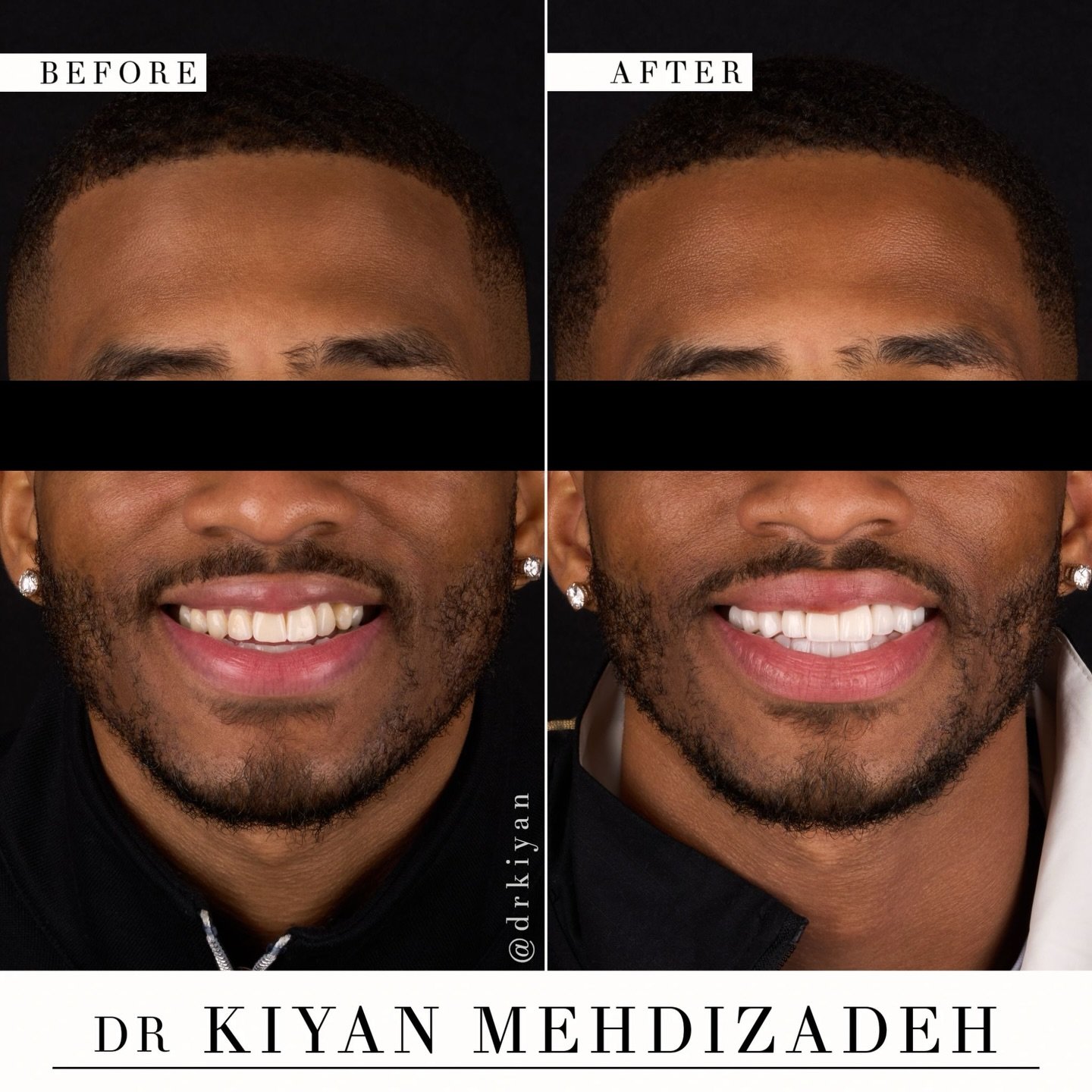 Correcting this patient&rsquo;s underbite transformed not only his smile, but his presence.

His alignment was problematic for two reasons: his lower teeth eclipsed his upper teeth, and his upper teeth were askew due to a missing canine tooth. This m