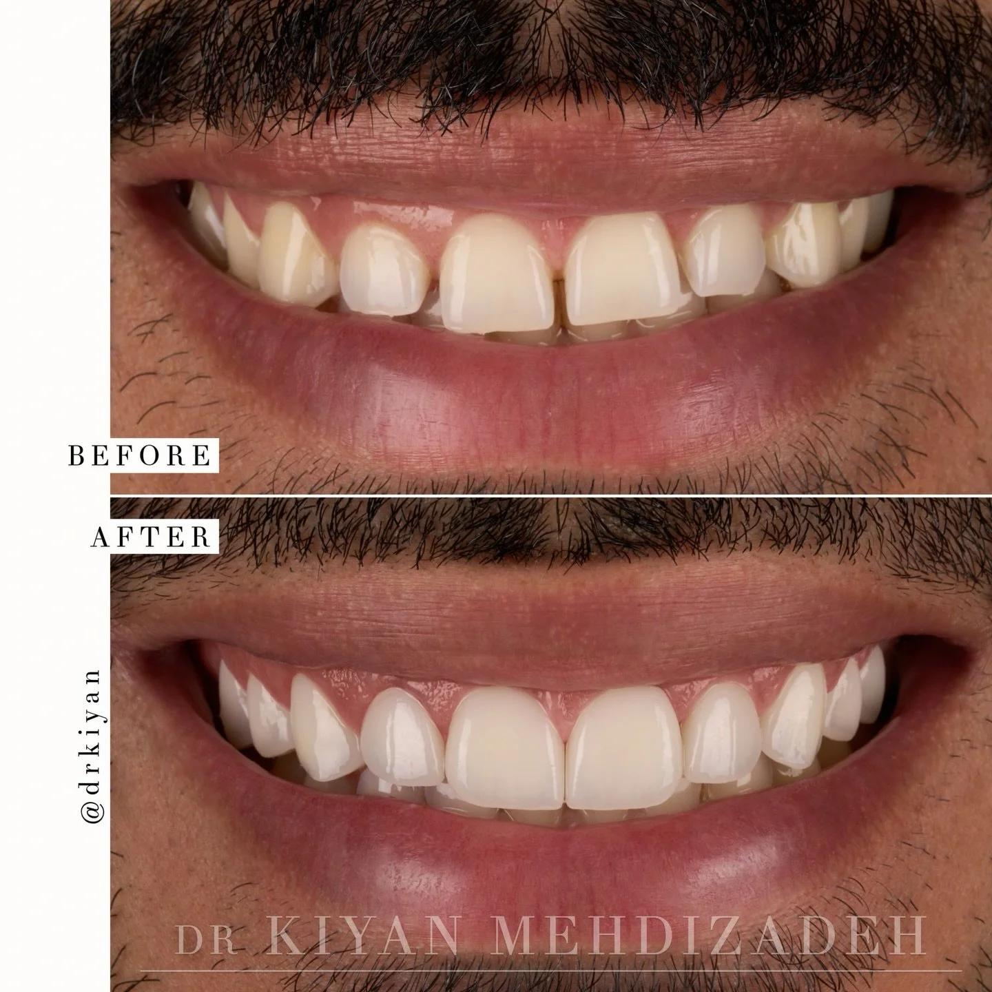 This lovely patient wanted a fuller smile.

His upper teeth were too small to meet at the edges, leaving small gaps between his front teeth. He sought a solution to eliminate those gaps while also making his smile brighter and symmetrical.

We design