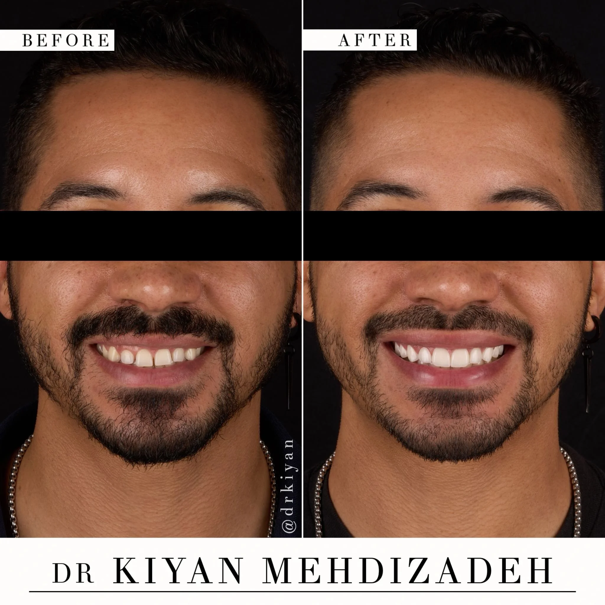 Thorough treatment planning goes a long way.

This patient wanted to close the gaps between his front teeth and improve the color and symmetry of his smile. Veneers will do this &mdash; but there is an important step to address before the design is e