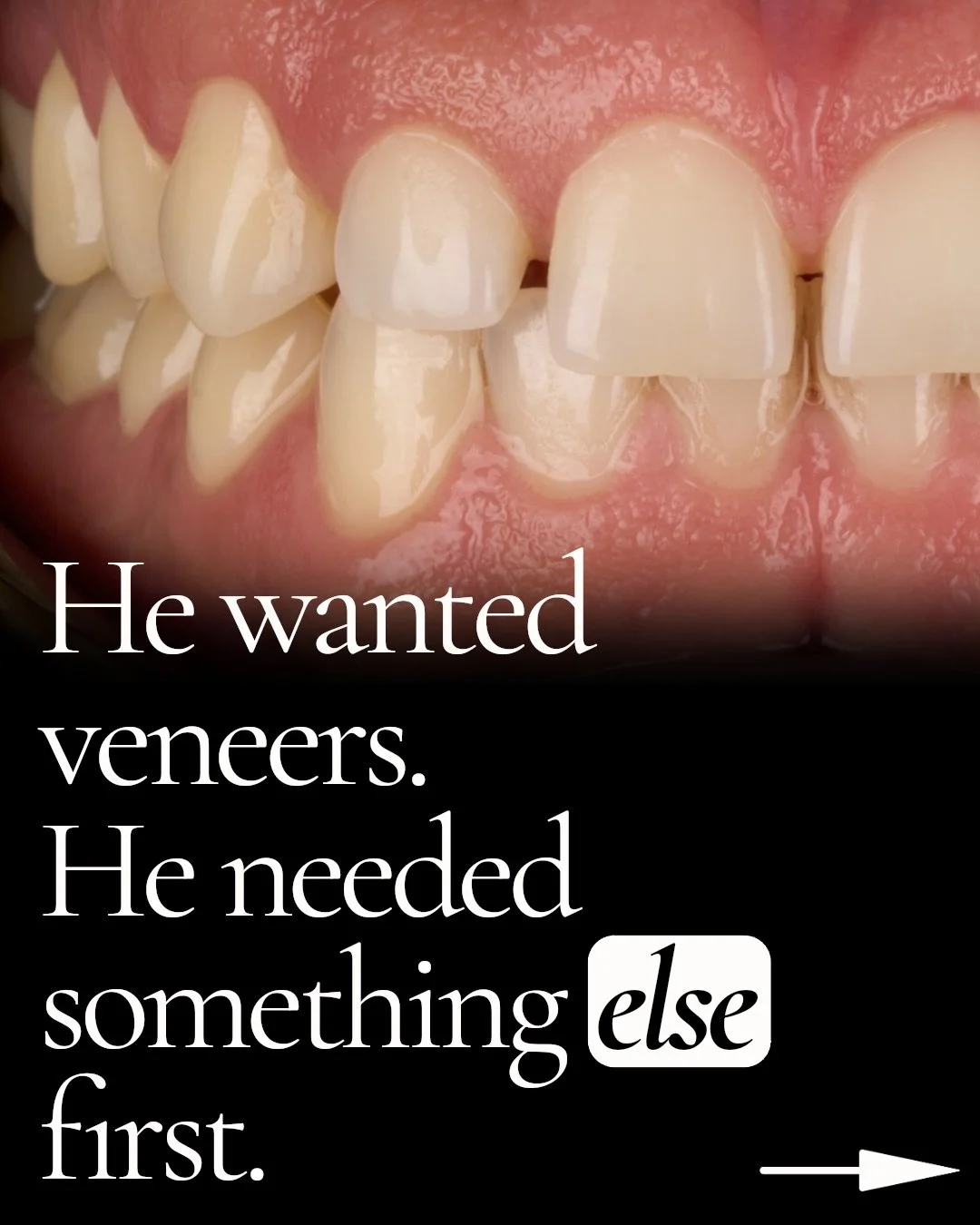 Sometimes, a smile restoration takes more than just veneers.

This lovely patient wanted a fuller smile, but simply making teeth &ldquo;bigger&rdquo; will not result in an aesthetic outcome. The foundation needed to be addressed first.

Once we perfo