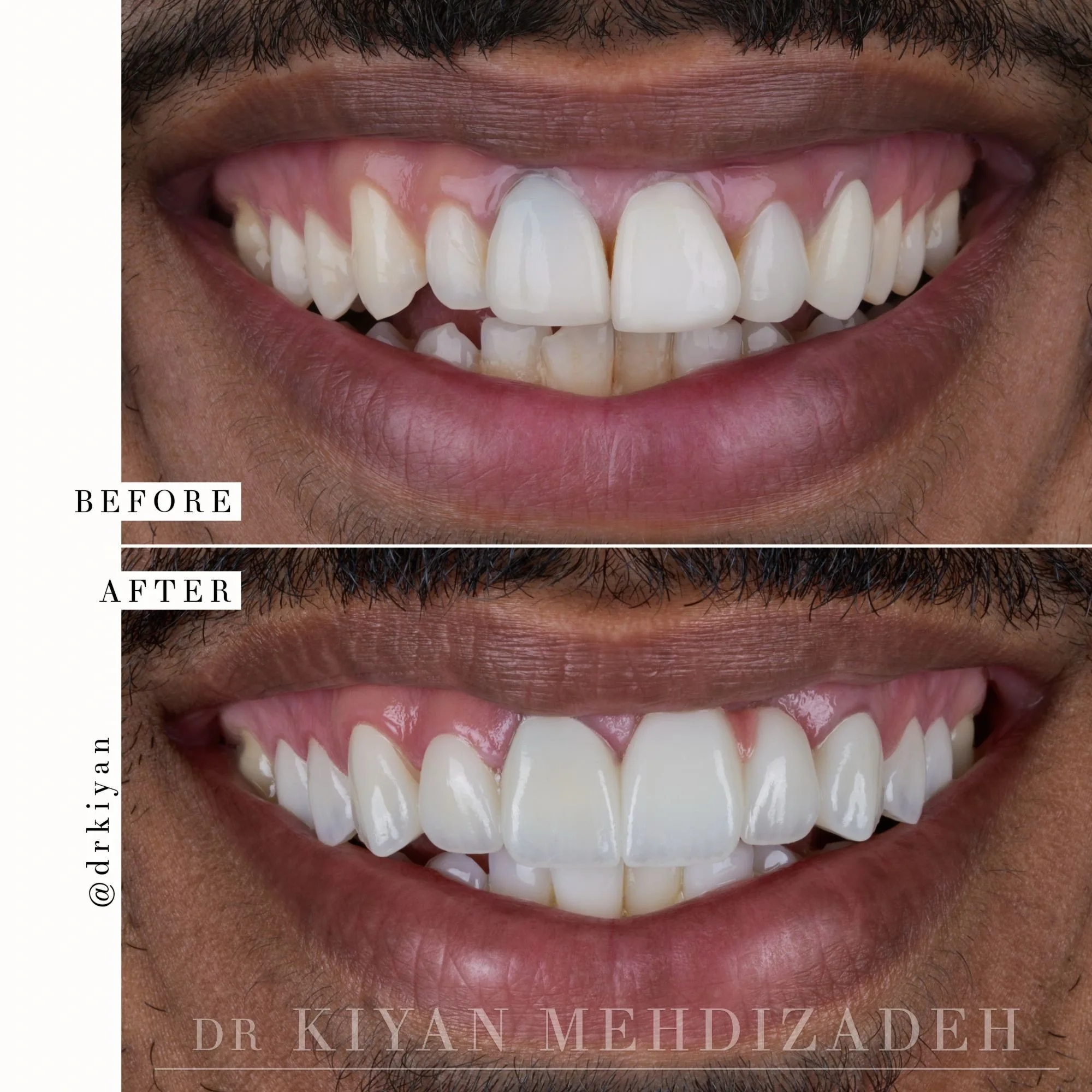 No smile transformation is the same.

This patient had two failed root canals resulting in an abscess forming above the front teeth. Due to the severity of the infection, two front teeth needed to be extracted.

The ideal treatment for this situation