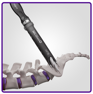SiLO TFX™ - Transfixing The SI Joint — Aurora - Simplifying The Complex ...