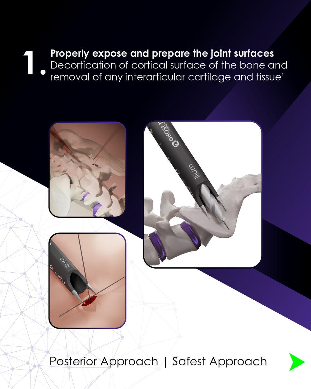 Transfix Screw SiLO TFX™ - Transfixing The SI Joint — Aurora - Simplifying The Complex ...