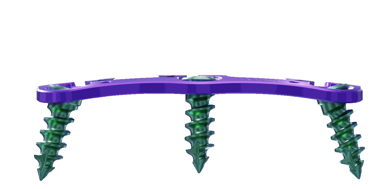 A purple cervical plate with green screws