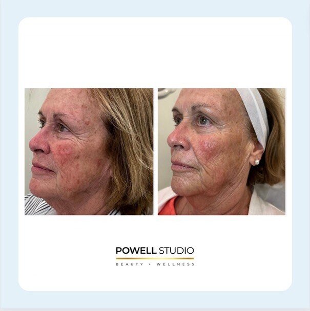 Summer Skin Is NOT In 

✨ Say goodbye to fine lines and your dead dull summer skin ✨

Your September Powell Promo&mdash;Grab 3 Sessions of Hollywood Ultra/Spectra Laser Facial + 20 units of Botox/Dysport for $1500!

You&rsquo;ll be glowing in no time