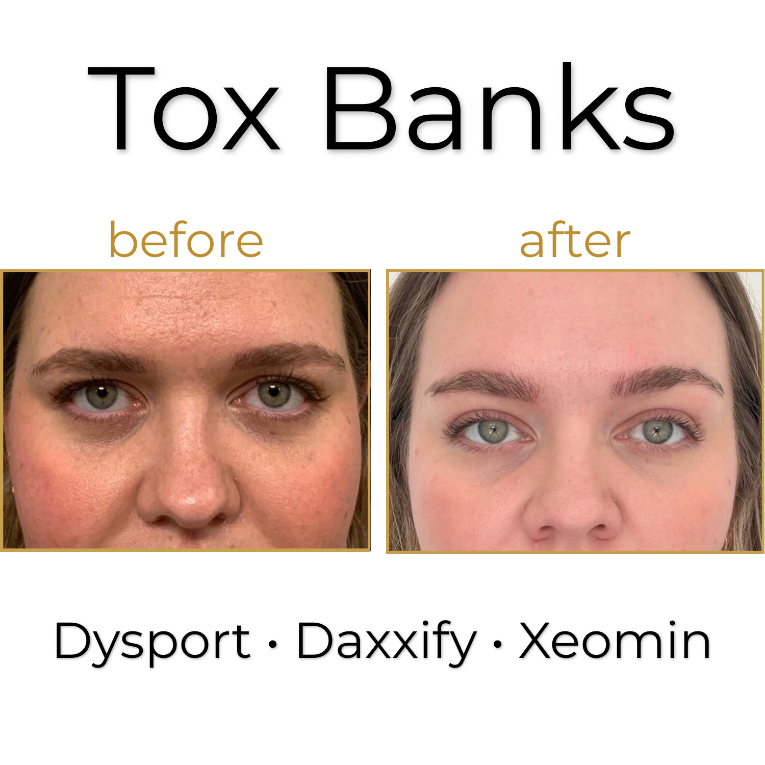 Christmas in July - 200 Unit Xeomin Bank