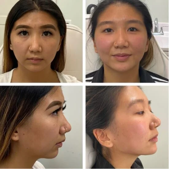facial-filler-before-after-powell-studio.jfif