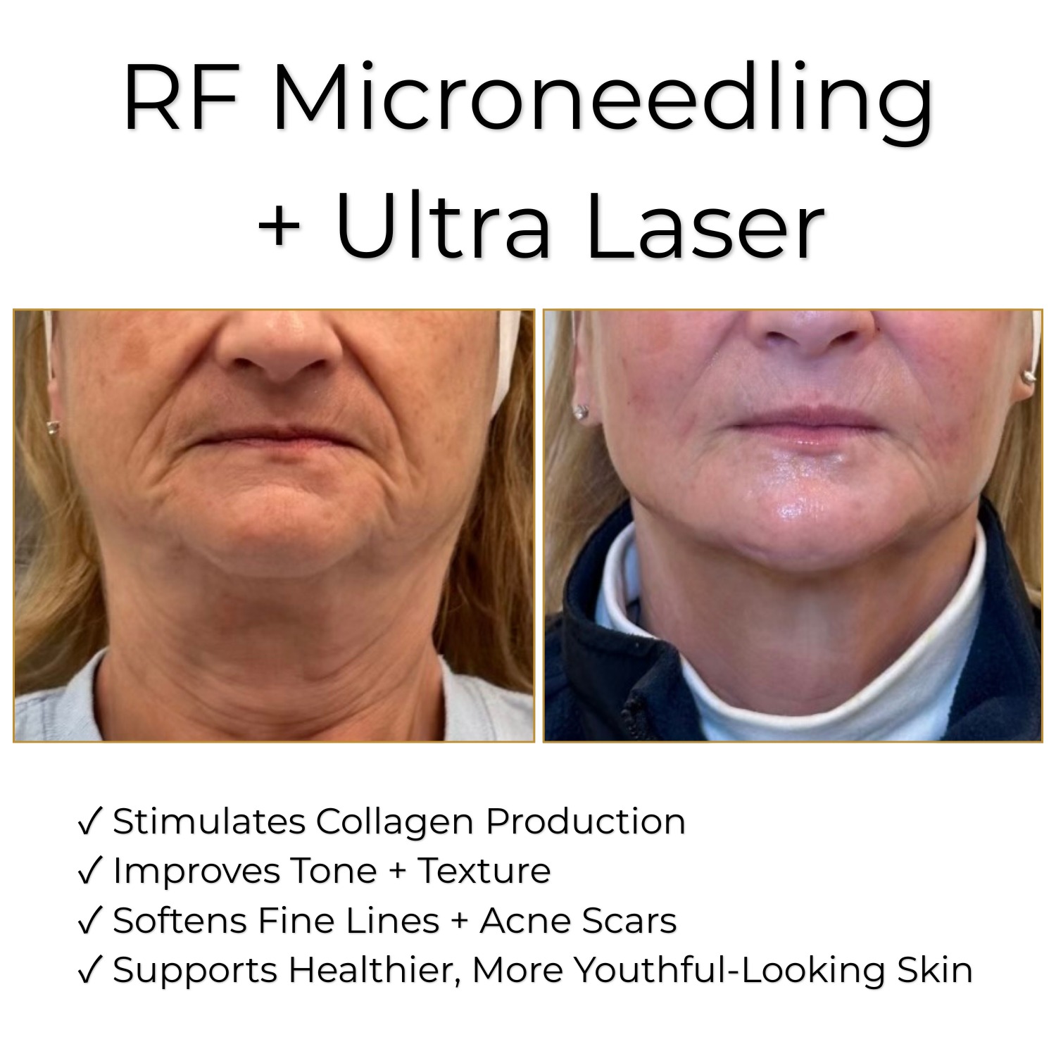 Christmas in July - RF Microneedling + Ultra Laser (3 sessions)