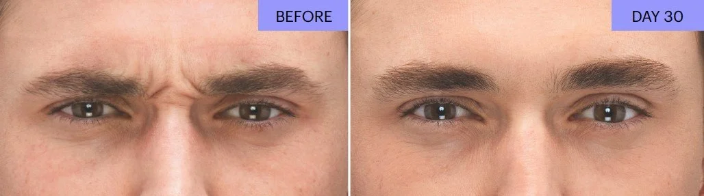 B+A Botox 7.jpg