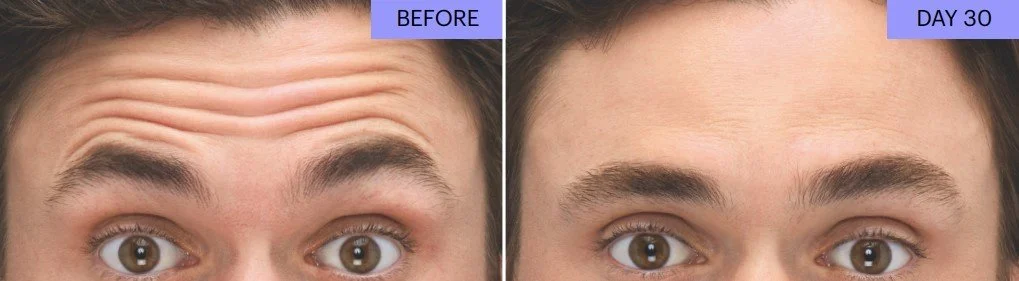B+A Botox 8.jpg