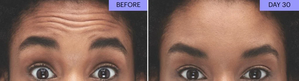 B+A Botox6.jpg