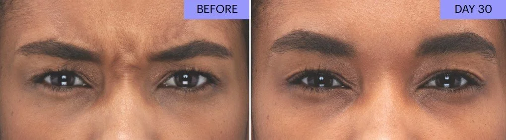 B+A Botox 4.jpg