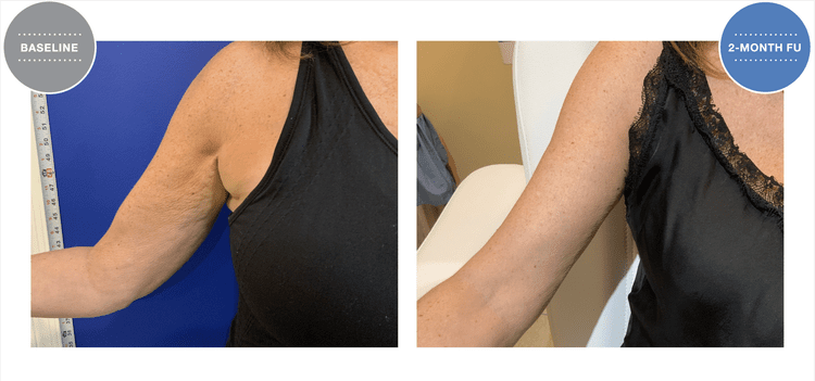 Arms