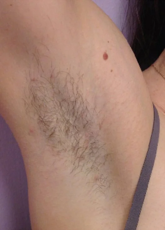 Laser hair removal before
