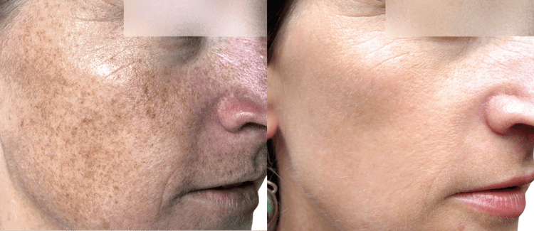 BBL pigmentation